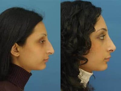 Ethnic Rhinoplasty Before & After Gallery - Patient 37904075 - Image 1