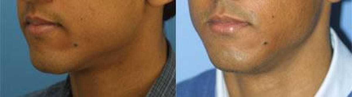Dermal Fillers Before & After Gallery - Patient 37903617 - Image 2