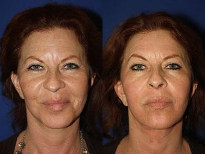 Laser Before & After Gallery - Patient 37904078 - Image 1