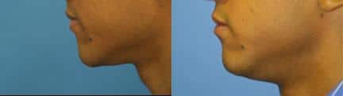 Lip Enhancement Before & After Gallery - Patient 37904067 - Image 3