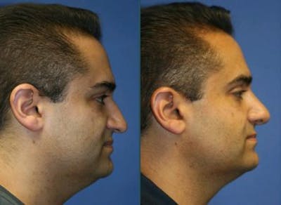 Ethnic Rhinoplasty Before & After Gallery - Patient 37904083 - Image 1