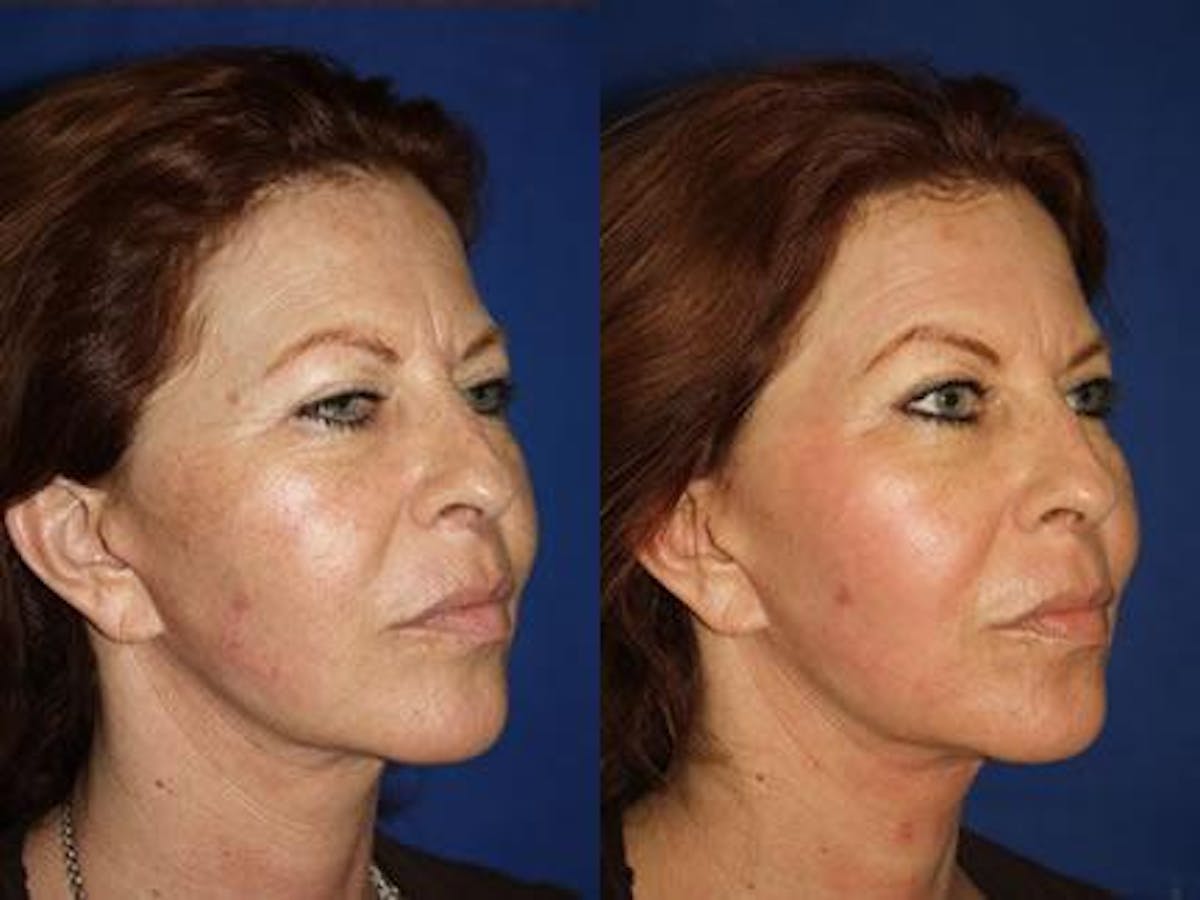 Laser Before & After Gallery - Patient 37904078 - Image 2