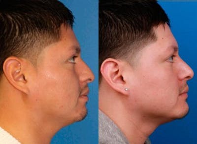 Ethnic Rhinoplasty Before & After Gallery - Patient 37904091 - Image 1