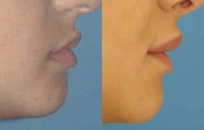 Lip Enhancement Before & After Gallery - Patient 37904092 - Image 1