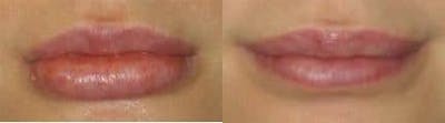 Lip Enhancement Before & After Gallery - Patient 37904098 - Image 1