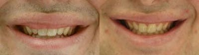 Lip Enhancement Before & After Gallery - Patient 37904104 - Image 1