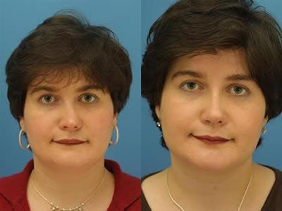 Nasal Fracture Repair Before & After Gallery - Patient 37904131 - Image 1
