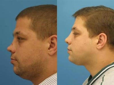 Nasal Fracture Repair Before & After Gallery - Patient 37904135 - Image 1