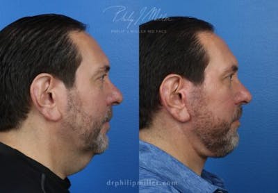 Neck Lift Before & After Gallery - Patient 37904141 - Image 1