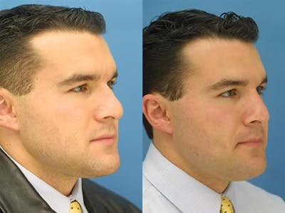 Nasal Fracture Repair Before & After Gallery - Patient 37904139 - Image 1