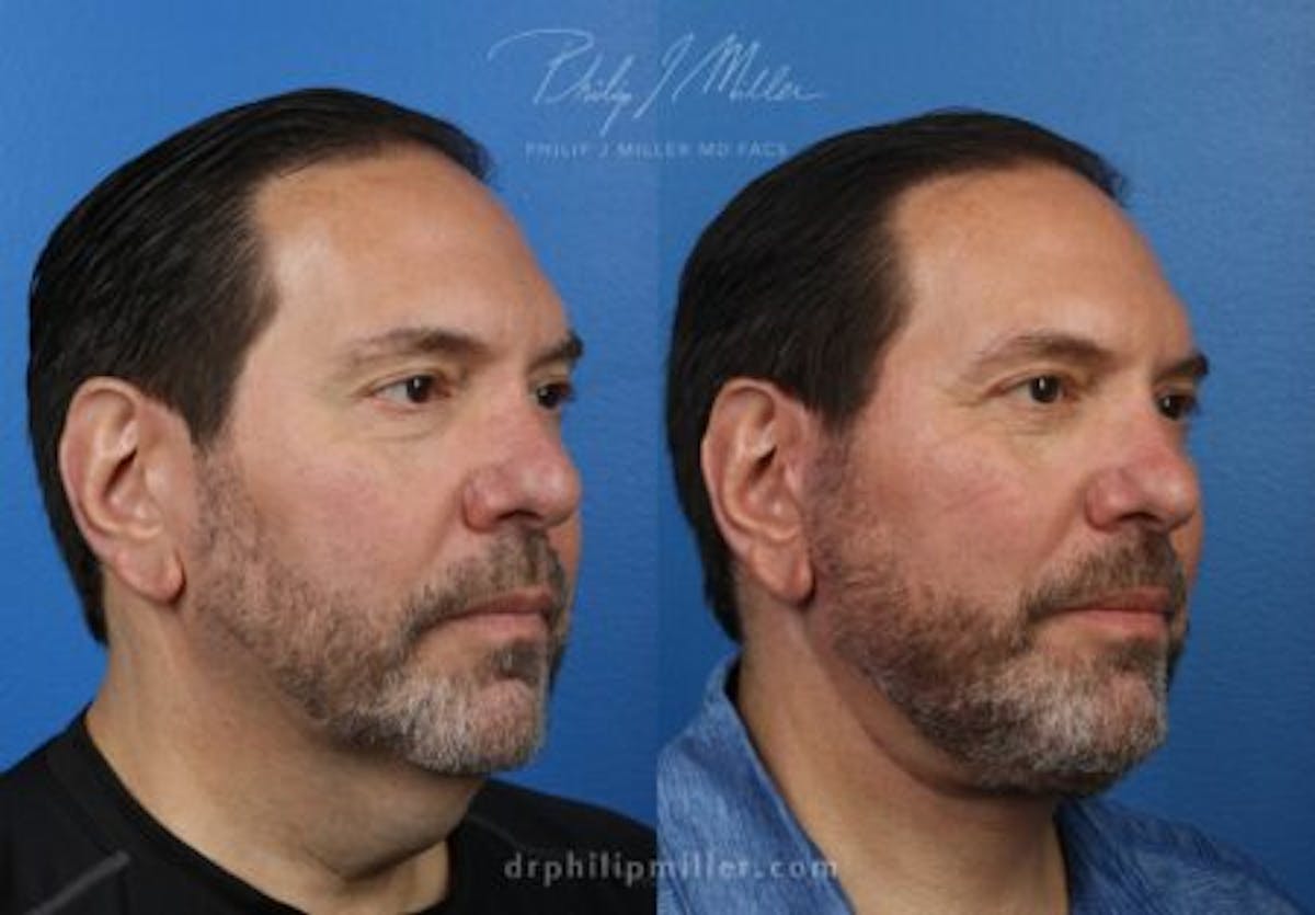 Neck Lift Before & After Gallery - Patient 37904141 - Image 2