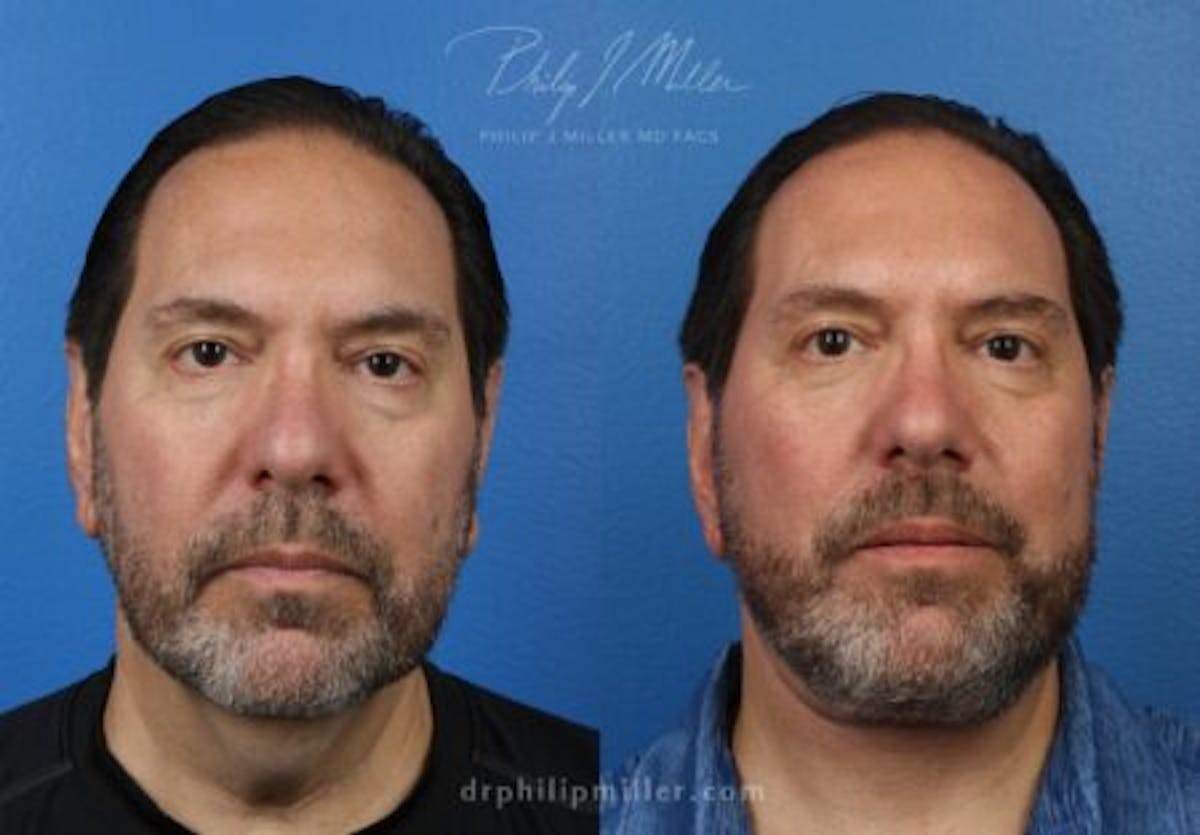Neck Lift Before & After Gallery - Patient 37904141 - Image 3