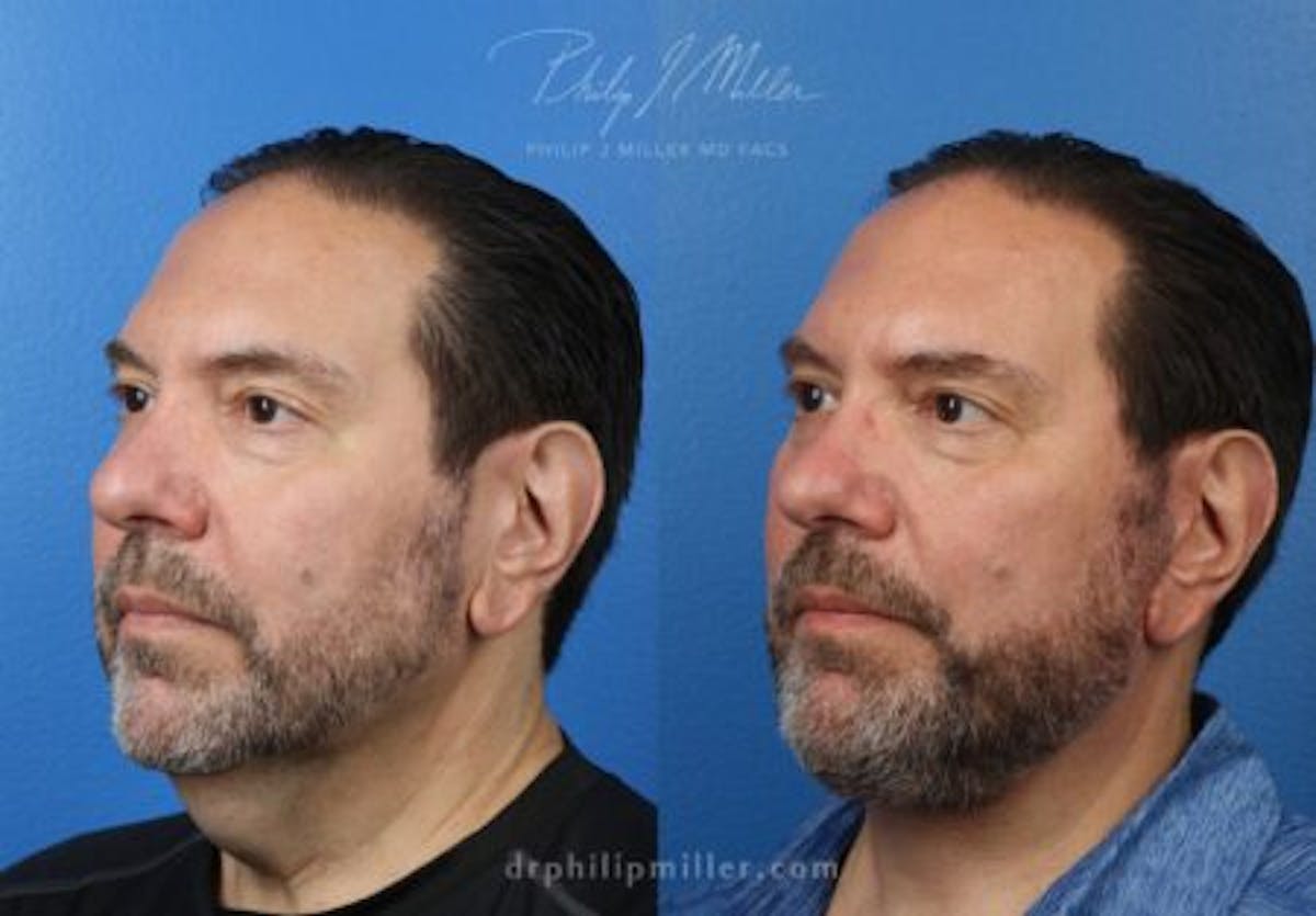 Neck Lift Before & After Gallery - Patient 37904141 - Image 4