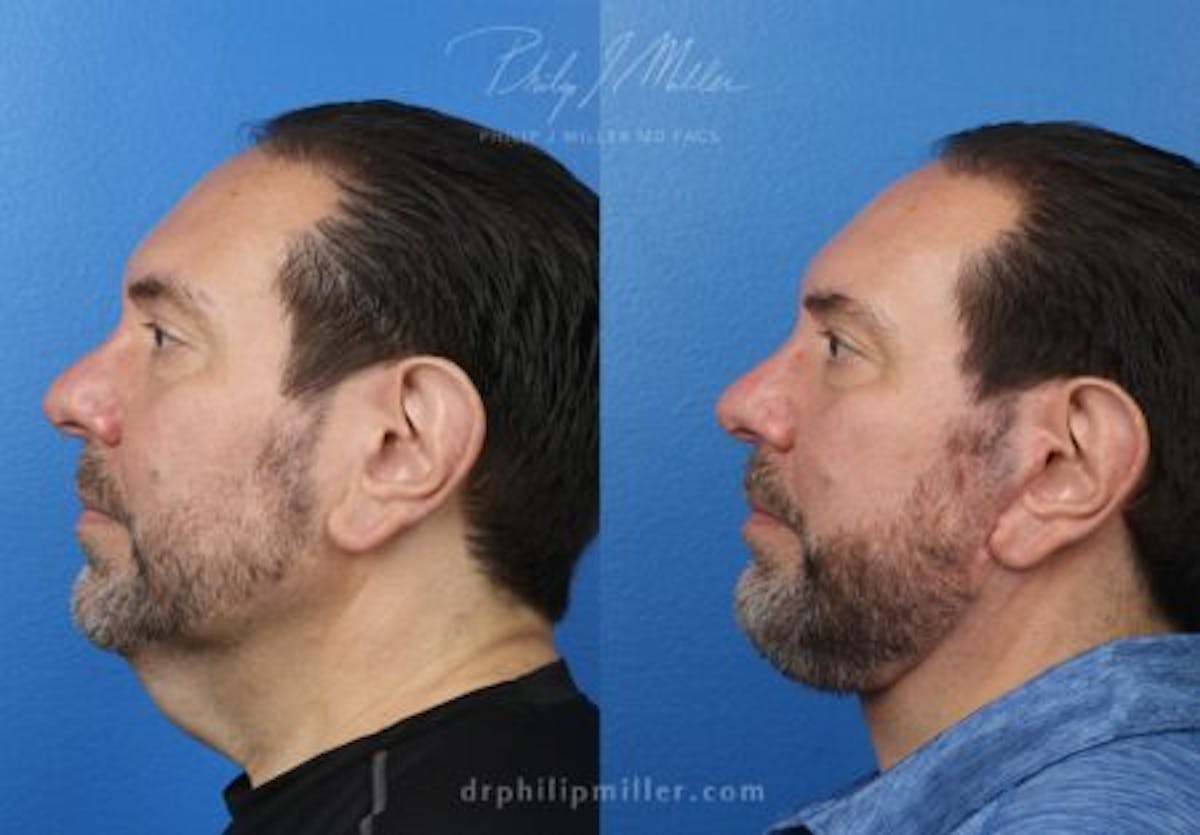 Neck Lift Before & After Gallery - Patient 37904141 - Image 5