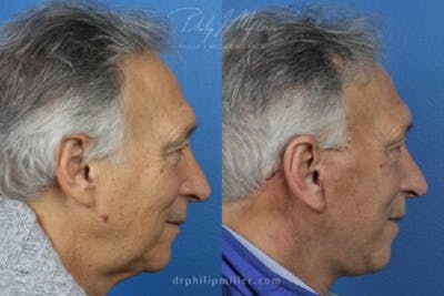 Neck Lift Before & After Gallery - Patient 37904158 - Image 1