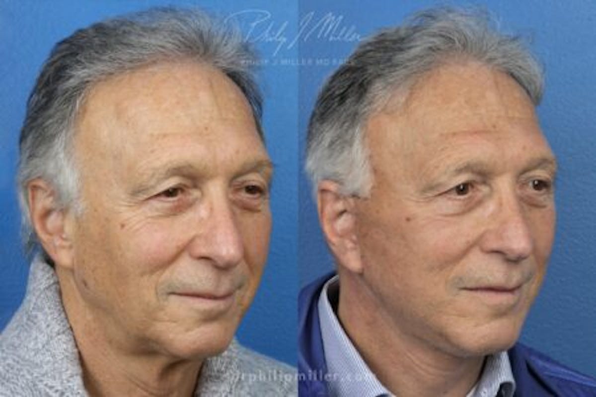 Neck Lift Before & After Gallery - Patient 37904158 - Image 2