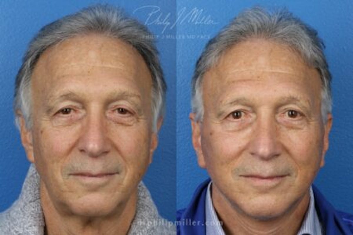 Neck Lift Before & After Gallery - Patient 37904158 - Image 3