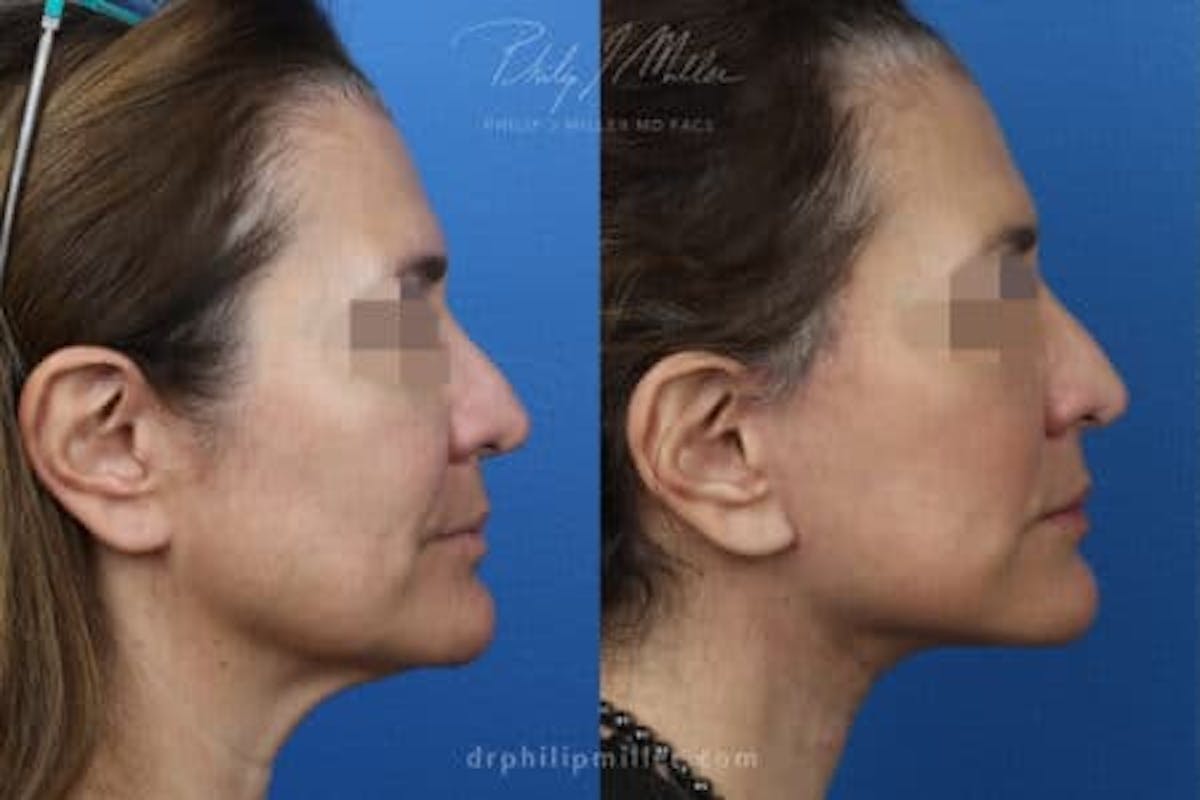 Necktite Before & After Gallery - Patient 37904167 - Image 2