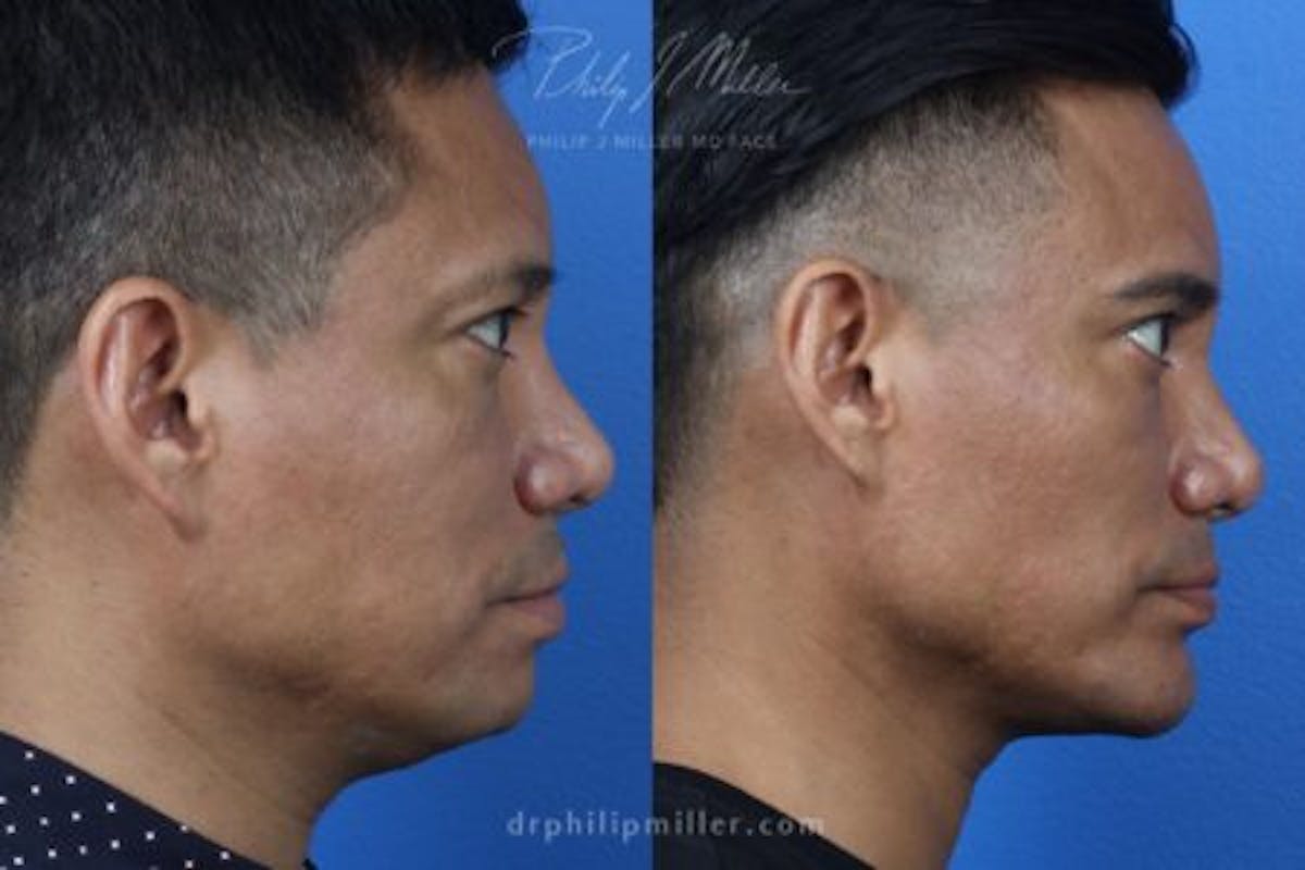 Necktite Before & After Gallery - Patient 37904176 - Image 2