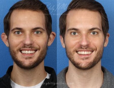 Otoplasty Before & After Gallery - Patient 37904181 - Image 1