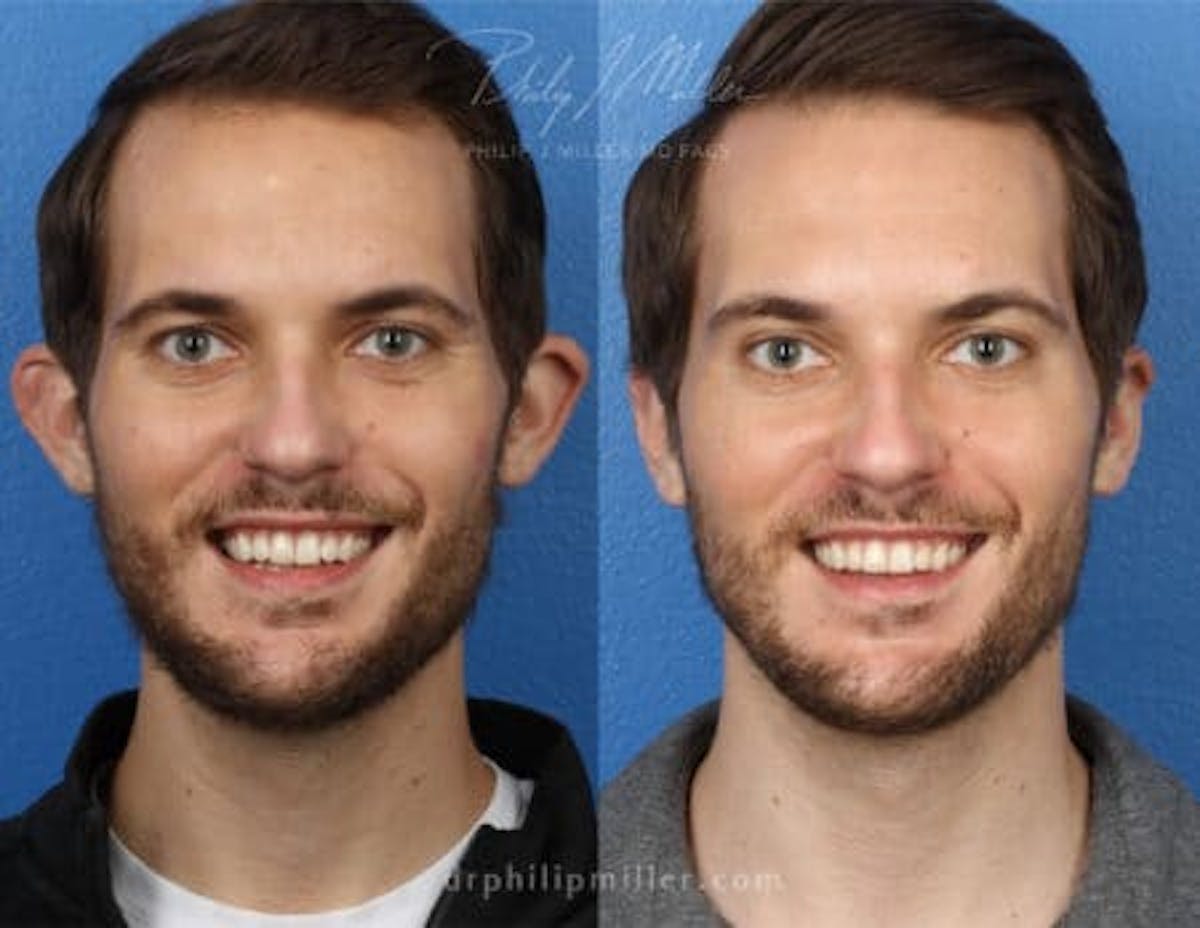 Otoplasty Before & After Gallery - Patient 37904181 - Image 1