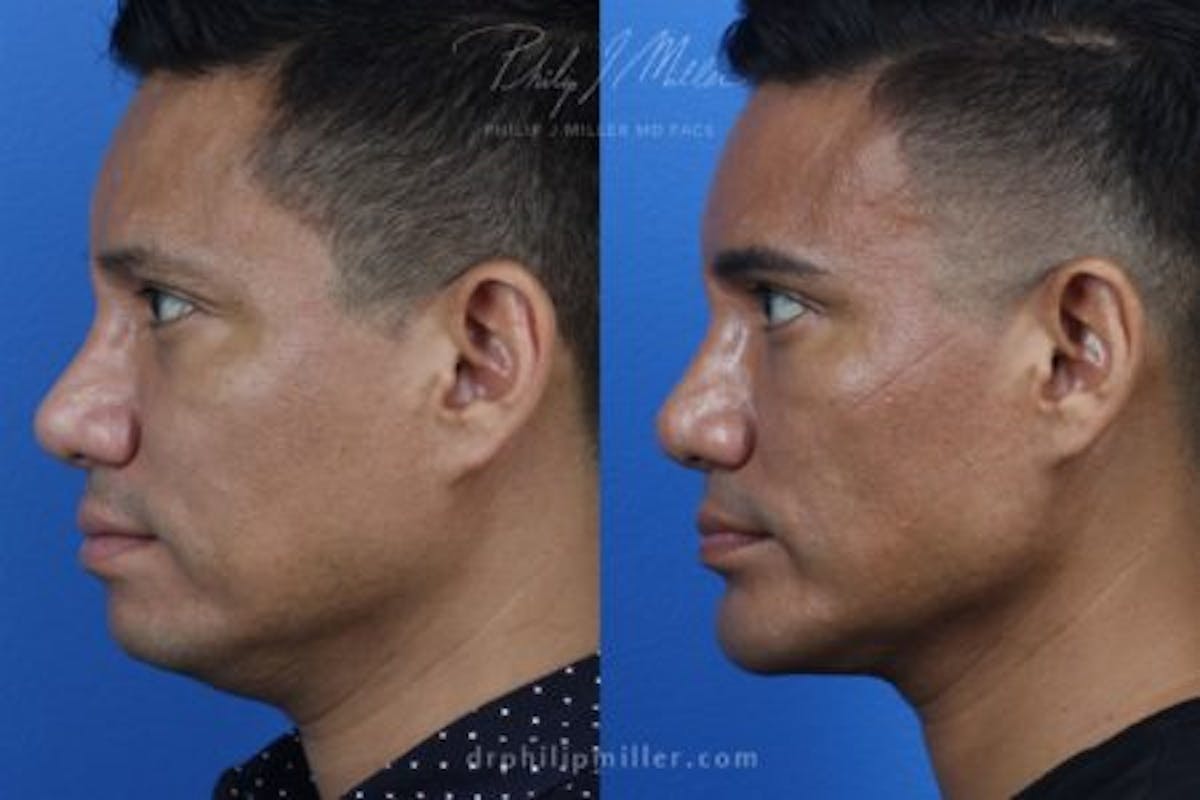 Necktite Before & After Gallery - Patient 37904176 - Image 3
