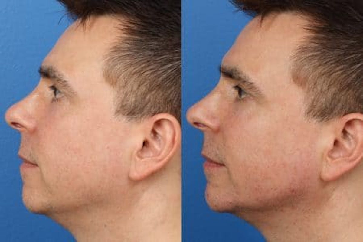 Necktite Before & After Gallery - Patient 37904191 - Image 2