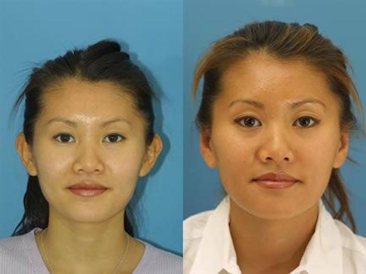 Otoplasty Before & After Gallery - Patient 37904197 - Image 1