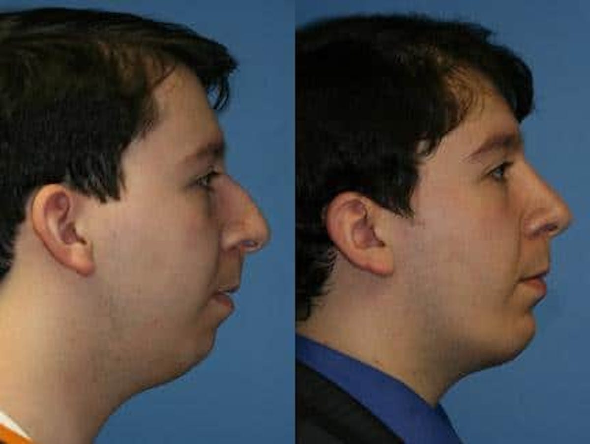 Otoplasty Before & After Gallery - Patient 37904206 - Image 1