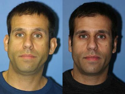 Otoplasty Before & After Gallery - Patient 37904248 - Image 1