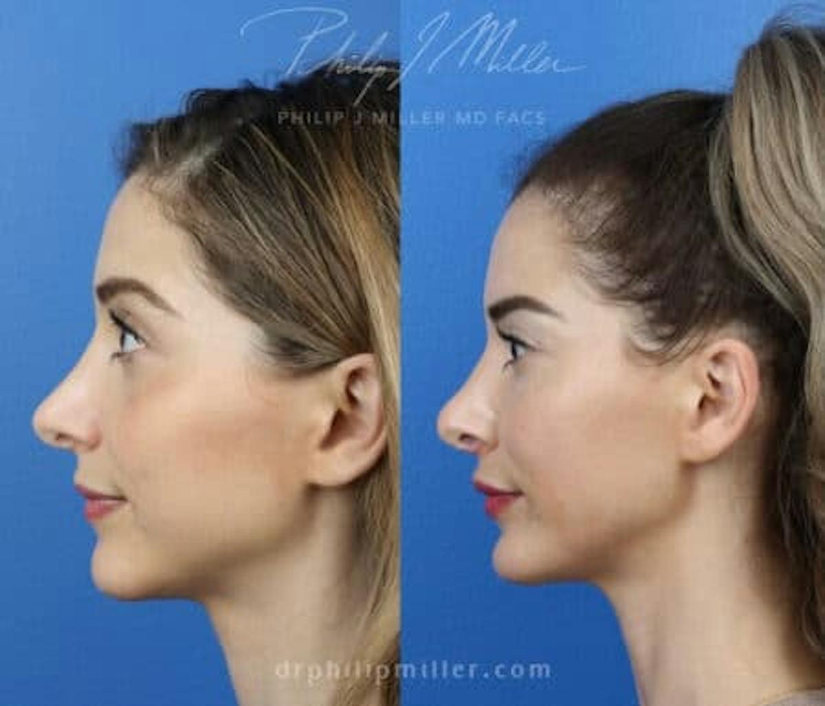 Revision Rhinoplasty Before & After Gallery - Patient 37904246 - Image 2