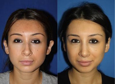 Otoplasty Before & After Gallery - Patient 37904253 - Image 1