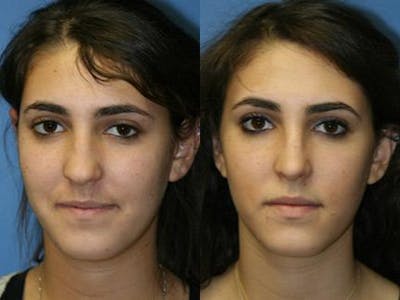 Revision Rhinoplasty Before & After Gallery - Patient 37904255 - Image 1