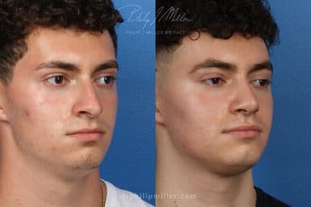 Rhinoplasty/NatraNose Before & After Gallery - Patient 37904268 - Image 2