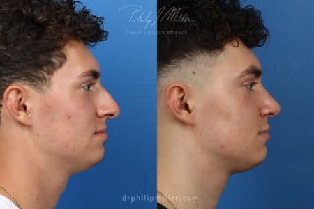 Rhinoplasty/NatraNose Before & After Gallery - Patient 37904268 - Image 3