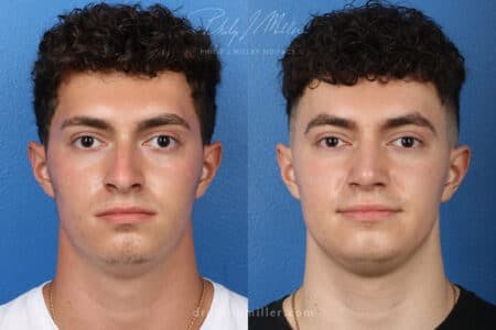 Rhinoplasty/NatraNose Before & After Gallery - Patient 37904268 - Image 4