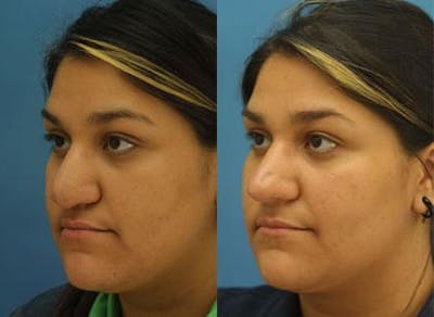 Revision Rhinoplasty Before & After Gallery - Patient 37904283 - Image 1