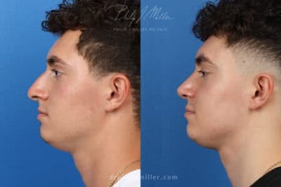 Rhinoplasty/NatraNose Before & After Gallery - Patient 37904268 - Image 1