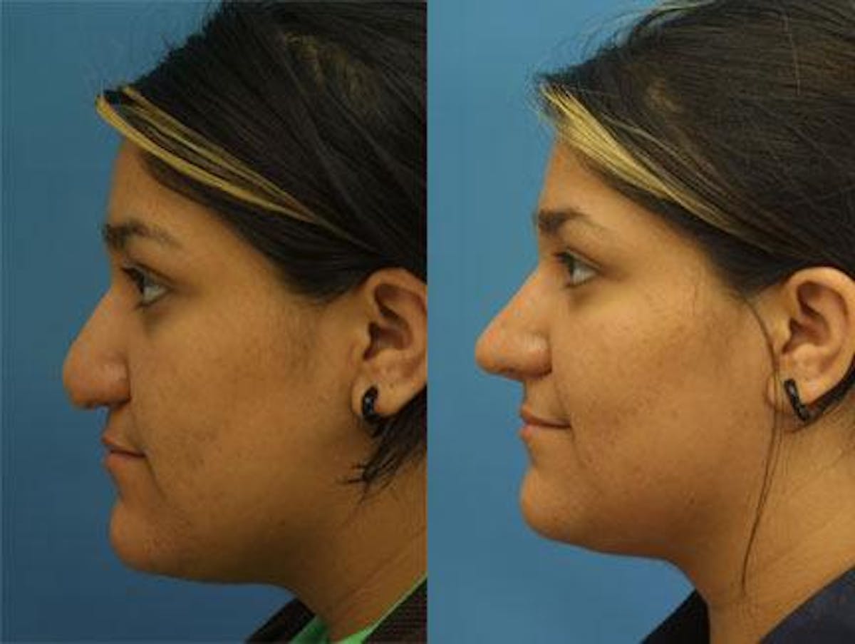 Revision Rhinoplasty Before & After Gallery - Patient 37904283 - Image 2
