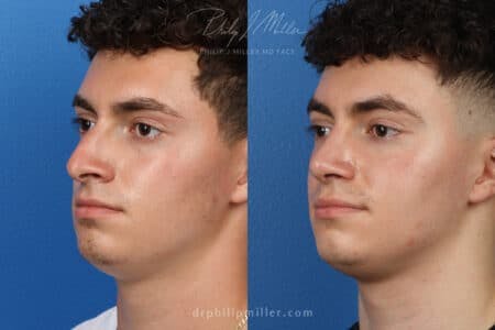 Rhinoplasty/NatraNose Before & After Gallery - Patient 37904268 - Image 5