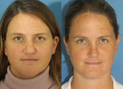 Revision Rhinoplasty Before & After Gallery - Patient 37904290 - Image 1