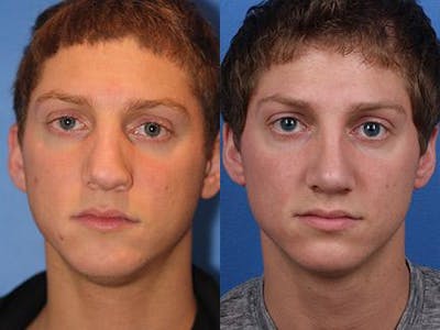 Revision Rhinoplasty Before & After Gallery - Patient 37904296 - Image 1