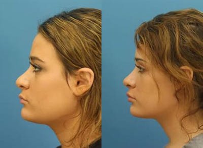 Revision Rhinoplasty Before & After Gallery - Patient 37904302 - Image 1
