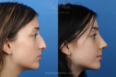 Rhinoplasty/NatraNose Before & After Gallery - Patient 37904305 - Image 1