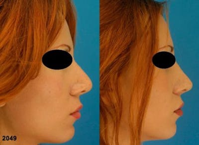 Revision Rhinoplasty Before & After Gallery - Patient 37904308 - Image 1