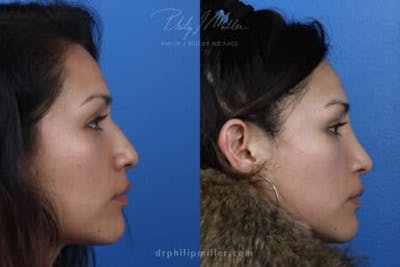 Rhinoplasty/NatraNose Before & After Gallery - Patient 37904311 - Image 1