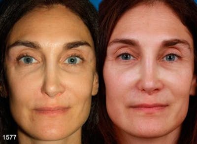 Revision Rhinoplasty Before & After Gallery - Patient 37904313 - Image 1