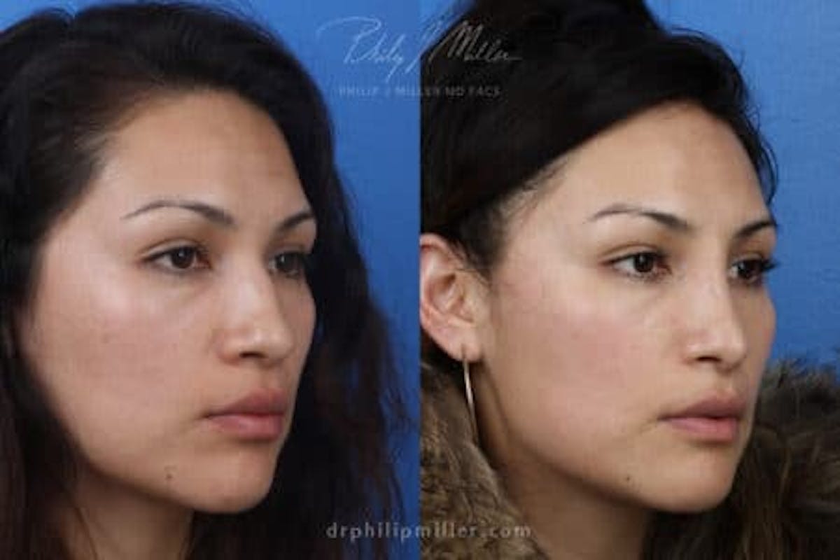 Ethnic Rhinoplasty Before & After Gallery - Patient 37902349 - Image 2