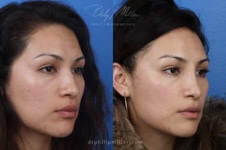 Rhinoplasty/NatraNose Before & After Gallery - Patient 37904311 - Image 2