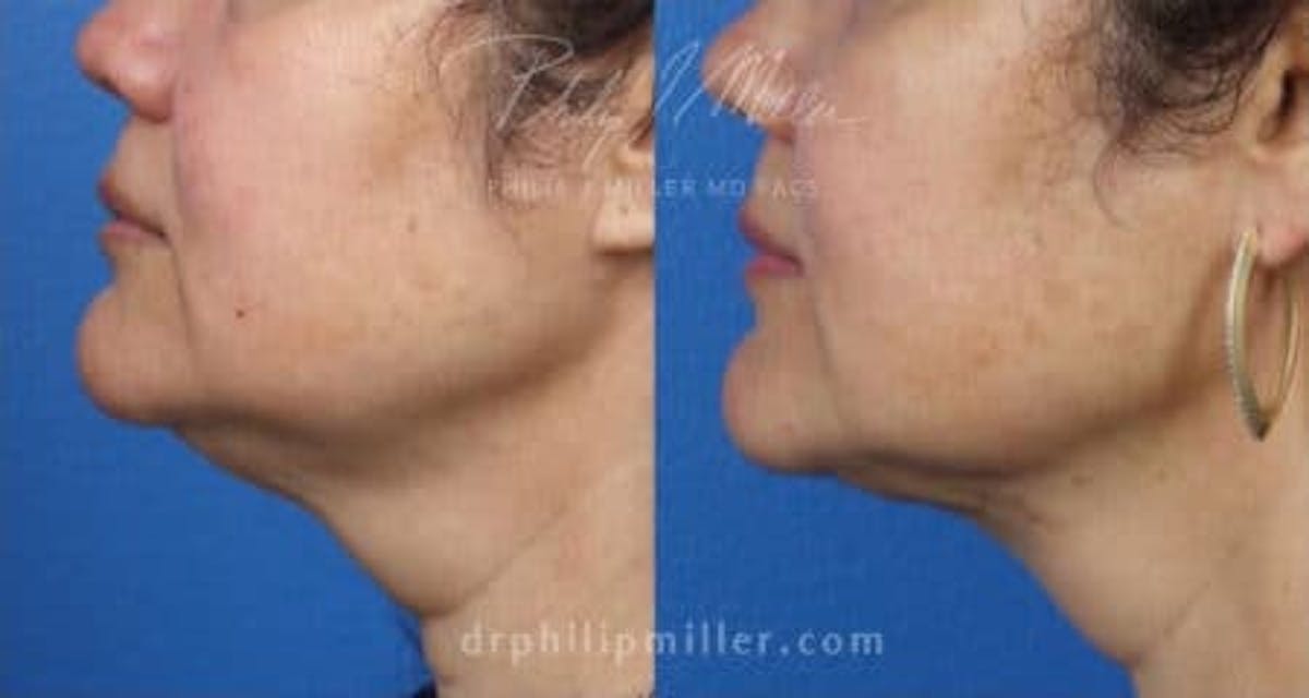 Skin Tightening Before & After Gallery - Patient 37904317 - Image 1